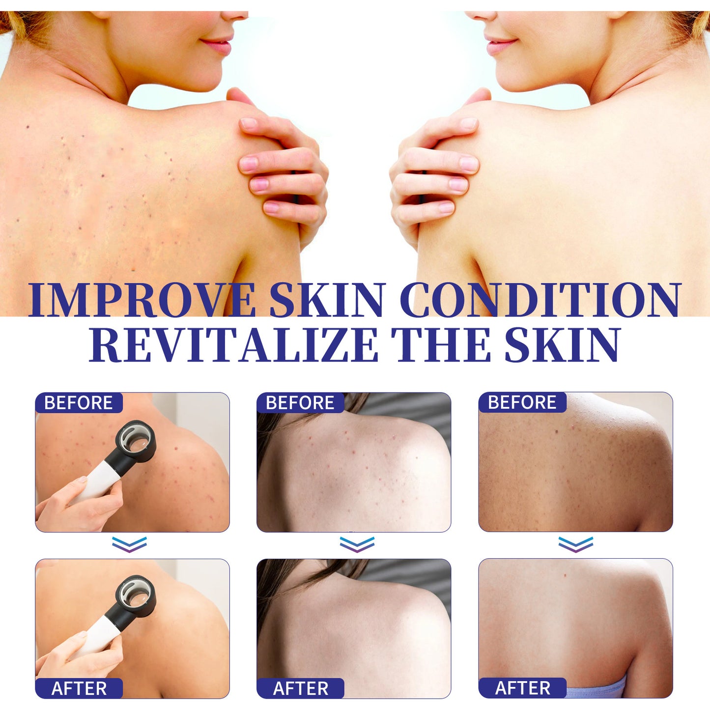 Back Care Spray Smallpox Diluting Back Acne Cleaning Repair